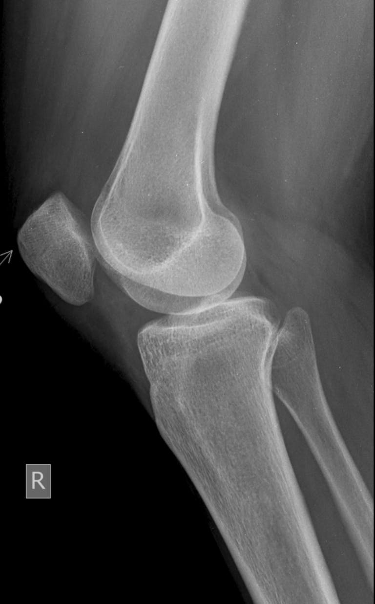 Detailed lateral view X-ray showing anatomy of human knee joint with clear bone structures.